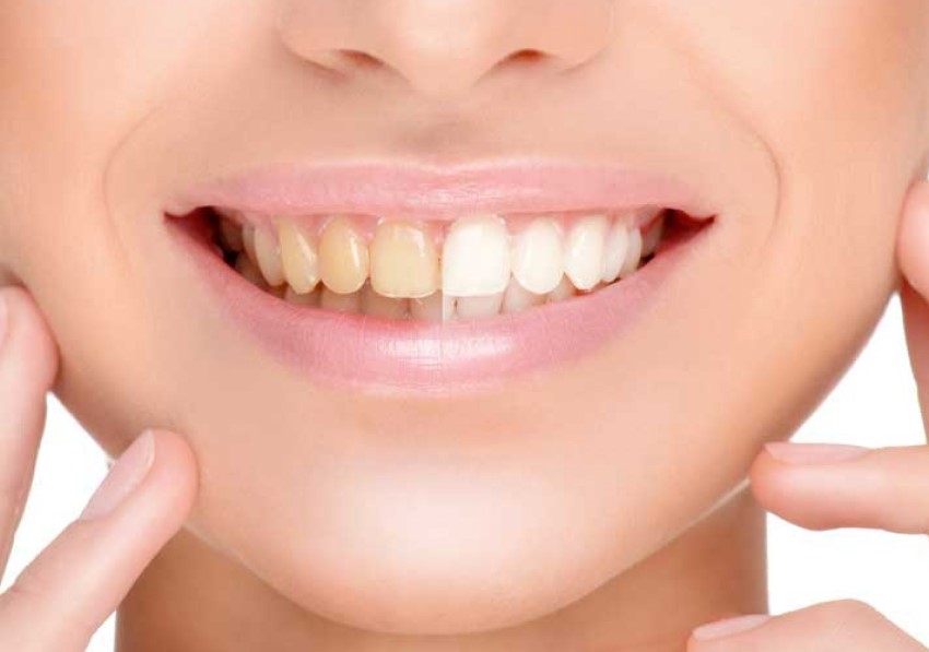 Quando parliamo di sbiancamento dei denti, il laser si configura come un’ottima alternativa al classico bleaching